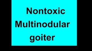 Nontoxic Multinodular goiter [upl. by Bryon547]