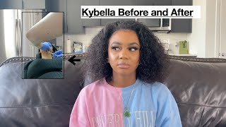 KYBELLA BEFORE AND AFTER [upl. by Salamone602]