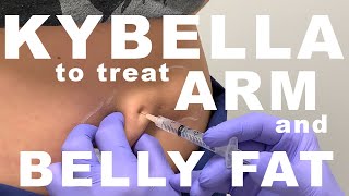 Kybella for Arm and Belly Fat  Dr Paul Ruff  West End Plastic Surgery [upl. by Gaylene]