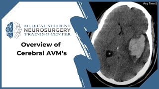 Accidente cerebrovascular isquémico [upl. by Behlau]