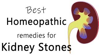 Best homeopathic medicine for stone in kidney  Dr Sanjay Panicker [upl. by Verneuil]