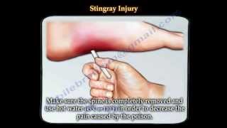 Stingray fish injury  Everything You Need To Know  Dr Nabil Ebraheim [upl. by Valeria620]