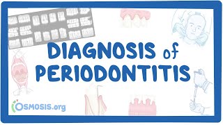 Diagnosis of Periodontitis [upl. by Surad]