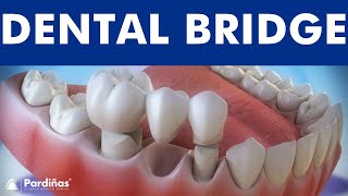 Dental bridge  Fixed dental replacement © [upl. by Studley]