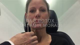 Botox in Depressor Anguli Oris DAO Muscle Dr Amir Moradi San Diego California [upl. by Nwotna982]