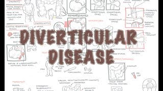 Diverticular Disease diverticulitis  Overview [upl. by Coffey]