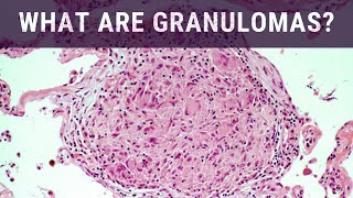 Medications for Chronic Granulomatous Disease [upl. by Andrea511]