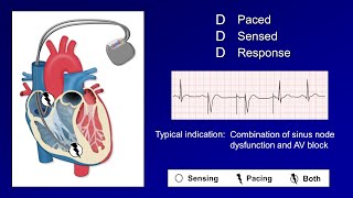 Pacemaker Modes and Settings [upl. by Vallonia976]