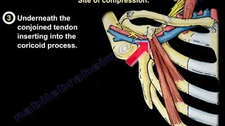 Thoracic Outlet Syndrome  Everything You Need To Know  Dr Nabil Ebraheim [upl. by Tad300]