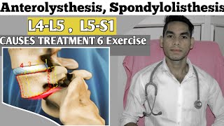 Spondylolisthesis The Most Dangerous Exercise To Avoid [upl. by Eelimaj414]