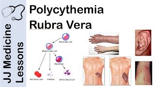 Polycythemia Rubra Vera  Pathophysiology Symptoms Diagnosis and Treatment [upl. by Milton571]