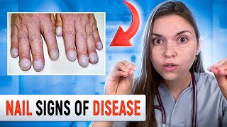 Doctor Explains what your NAILS say about your HEALTH Top 10 Nail Problems [upl. by Euqimod]