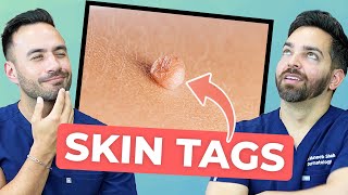 HOW TO TREAT SKIN TAGS LIKE A DERMATOLOGIST [upl. by Caputto873]