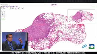 Granulomatosis with Polyangiitis pathophysiology symptoms treatment [upl. by Ettenotna]