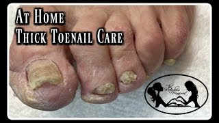 Pedicure At Home Elderly Toenails Cutting Thick Toenails and Nail Fungus [upl. by Sears]