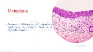 Cellular adaptation Metaplasia [upl. by Farrish]