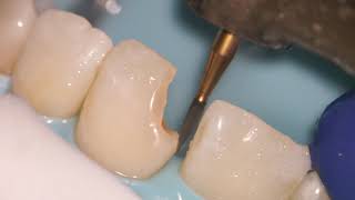 Teeth Bonding  Front tooth filling EXPLAINED [upl. by Amiaj]