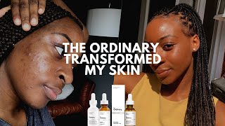 The Ordinary Skin Transformation Mandelic Acid Cleared My Acne  xoreni [upl. by Yesak]