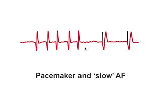 Pacemaker Issues Explained Part 2 Decoding Undersensing [upl. by Hukill]