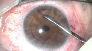 DMEK surgery sutureless corneal transplant [upl. by Salahcin]