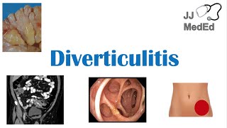 Diverticulitis Diet How to Treat It Naturally [upl. by Tsew]