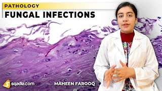 Fungal Infections  Candida  Pathology Video Lectures  VLearning  sqadiacom [upl. by Ennire]