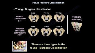 Pelvic Fractures  Everything You Need To Know  Dr Nabil Ebraheim [upl. by Cleopatre194]