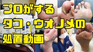 魚の目処置【プロがする痛くないフットケア】 [upl. by Gittle]