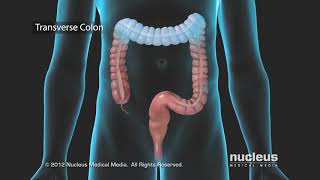 Diverticulitis Diet  WebMD [upl. by Anabal475]