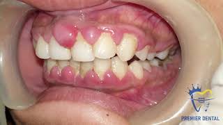 Severe gingivitis amp gingival hyperplasia [upl. by Neeven]