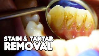 Dental Cleaning EXPLAINED  Stain amp Tartar Removal [upl. by Seftton]