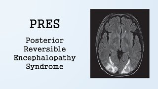 PRES Posterior Reversible Encephalopathy Syndrome [upl. by Arabelle819]