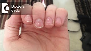 10 Ways To Get Rid of Vertical Ridges On Nails as Per Dermatologist [upl. by Goddard38]