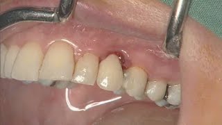 NobelActive clinical case immediate implant placement  Eric Rompen [upl. by Ebocaj]