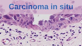 What is Carcinoma in situ  Pathology mini tutorial [upl. by Eillim]