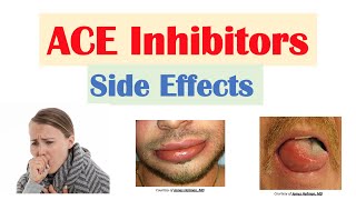 ACE Inhibitor Side Effects Lisinopril Ramipril Captopril Perindopril  Causes and Why They Occur [upl. by Gillian]