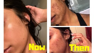 THE ORDINARY SKINCARE  HOW TO GET RID OF DARK SPOTS [upl. by Hornstein]