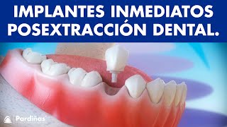 Implantes dentales inmediatos posextracción dental © [upl. by Hasheem466]