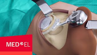 BONEBRIDGE BCI 602 Implant Surgery  MEDEL [upl. by Ycnaf872]