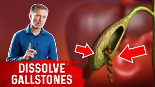 Do This to Help Dissolve Gallstones [upl. by Daren]