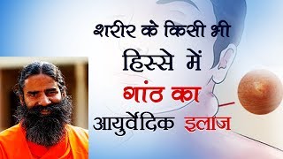 शरीर के किसी भी हिस्से में गांठ का आयुर्वेदिक इलाज  Swami Ramdev [upl. by Leandra]