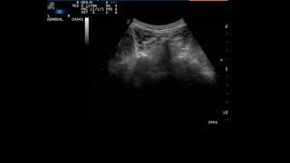 Ultrasound guided facet joint injection 2 L5S1 [upl. by Rickey]