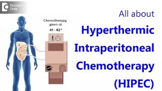 All about Hyperthermic Intraperitoneal ChemotherapyHIPEC [upl. by Igiul]