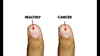 9 Fingernails serious alarming health issues and probllems [upl. by Neehahs]