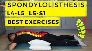 Spondylolisthesis treatment [upl. by Roxie34]