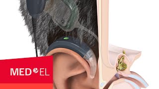 How Do Cochlear Implants Work  MEDEL [upl. by Trinia]