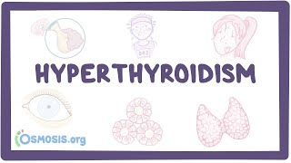 Hyperthyroidism  an Osmosis Preview [upl. by Nyladgam615]