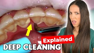 Dental Hygienist Explains Deep Cleaning Procedure [upl. by Ainahpets]