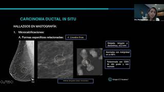 Carcinoma ductal in situ [upl. by Ainig]