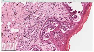 Ductal carcinoma in situ are we overtreating it [upl. by Gregory761]